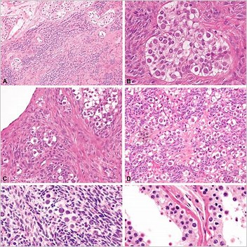 Sex Cordgonadal Stromal Tumour Cleanup Tagged Articles Without A Reason Field